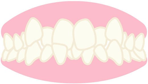 Dental Occlusion - The Basics of Our Health
