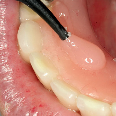 Acrifix Kuss Dental - Seringue 3 gr Résine Photo Rose. - Massilia Dental - Fournitures Matériel Cabinet Dentaire