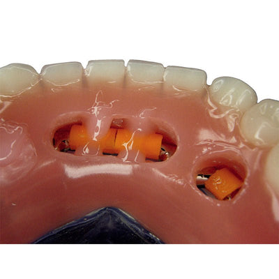 Acrifix Kuss Dental - Seringue 3 gr Résine Photo Rose. - Massilia Dental - Fournitures Matériel Cabinet Dentaire