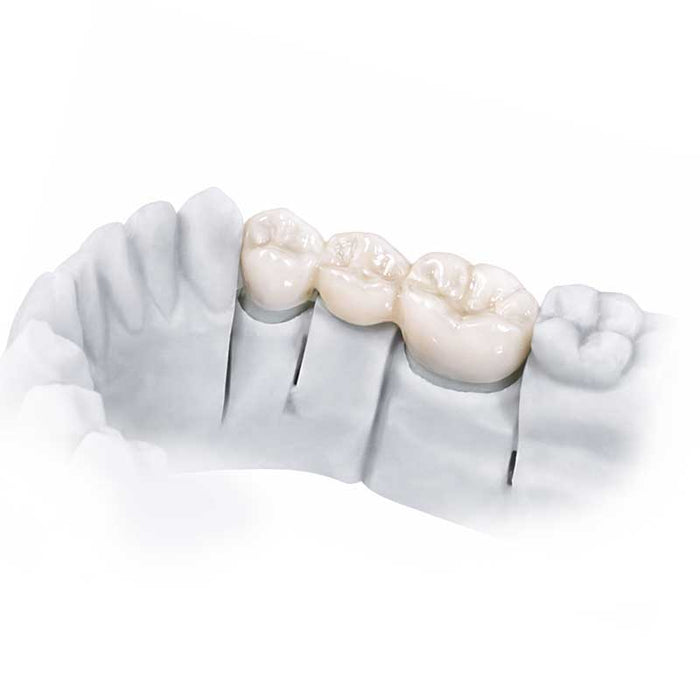 3D Temporary Freeprint resin - Printing for provisional crowns.
