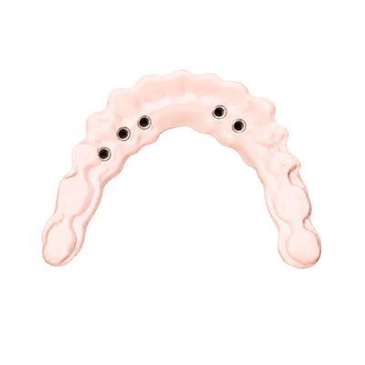 Trilor rose disque fibre de verre armature implantaire sans métal 