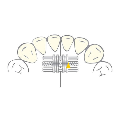 Vector 100 mini vérin ortho - Scheu Dental 10  pièces shema