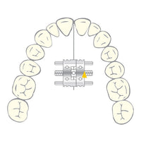 Vector 200 Mini Vérin Orthodontique - Scheu Dental - 10 U - Massilia Dental - Fournitures Matériel Cabinet Dentaire