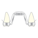 alt="Vector 600 vérin expansion palatin Scheu Dental shema - Massilia Dental"